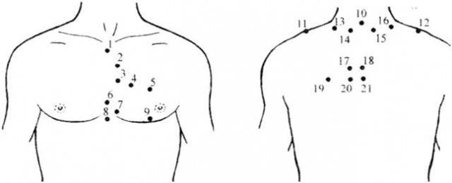 лікування стенокардії